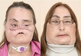 Американка с пересаженным лицом 46-летняя Кони Кальф
