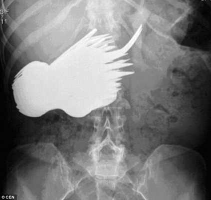 Шокирующий рентгеновский снимок, похожий на кальмара. На самом деле это желудок женщины, проглотившей 78 вилок и ложек