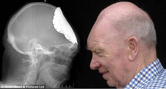 Слева: ренген Гордона Мур с металлической пластиной; справа: Гордон Мур без пластины, у него выросла собственная черепная кость