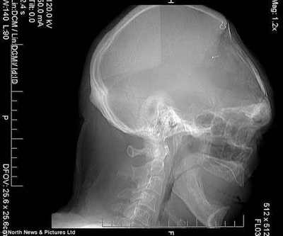 У британца Гордона Мура выросла новая черепная костная ткань спустя 50 лет после автомобильной аварии