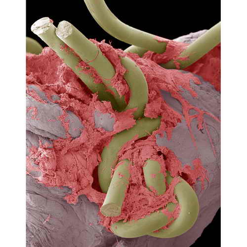 Электронная микрофотография наложения шва, сделанного в кишечнике с помощью хирургических нитей. Такие нити делаются из микрофиламентного нейлона и могут быть толщиной меньше человеческого волоса