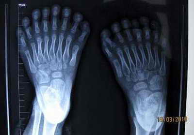 Рентген: мальчик с лишними пальцами