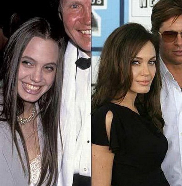 Анджелина Джоли до и после