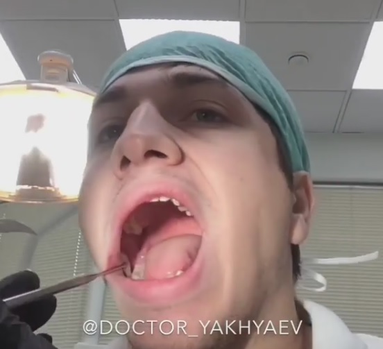Стоматолог удалил зуб мудрости