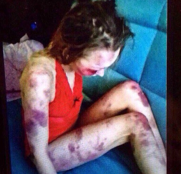 Анастасия Овсянникова жертва насилия избиение