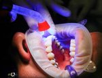 Мягкие зубные протезы из нейлона – разновидности, основные плюсы и минусы