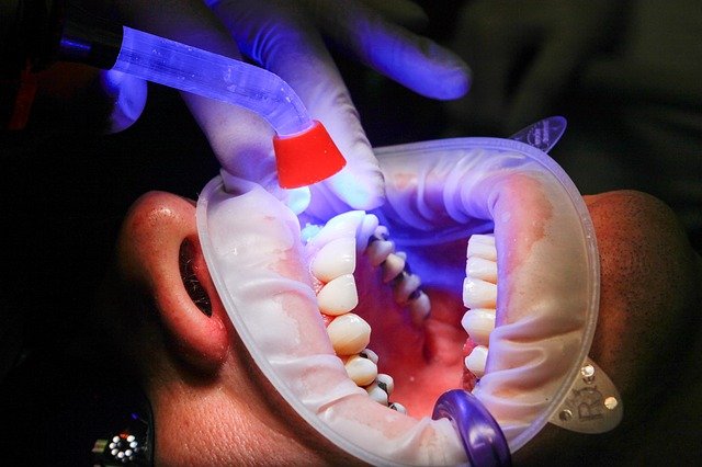 Мягкие зубные протезы из нейлона – разновидности, основные плюсы и минусы